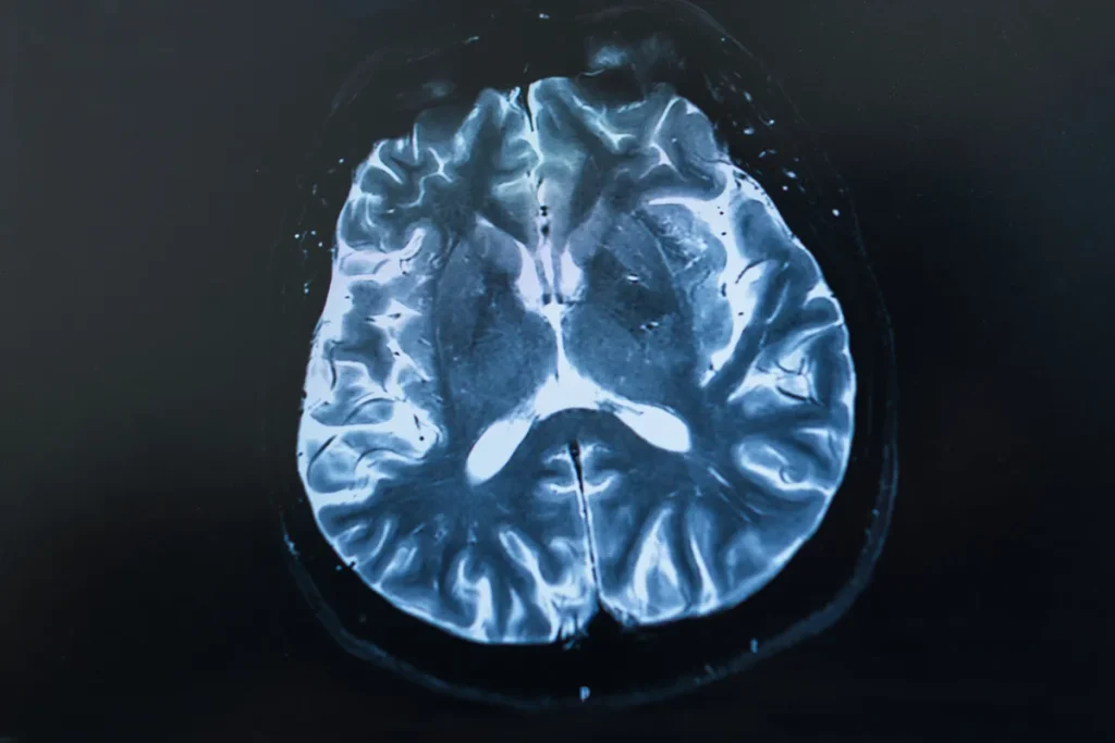 9. terület: az idegrendszer összeomlása és az epilepszia
